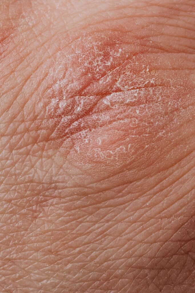 vitamin deficiency dry skin